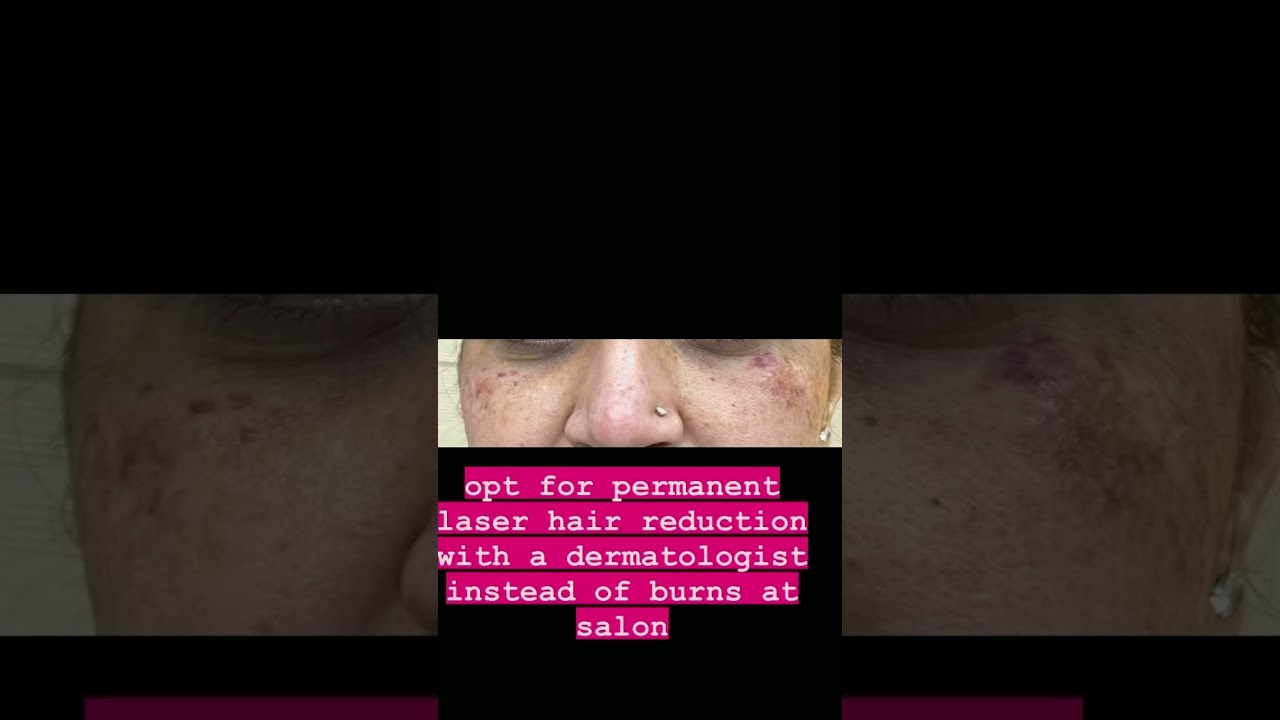 Opt for Permanent Laser Hair ReductionPost waxing BurnsPermanent