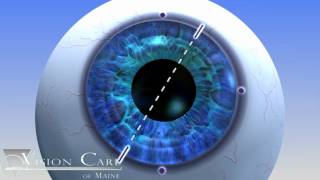 Alcon Toric Lens at Vision Care of Maine