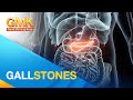 Gallstones: saan ito nakukuha at paano ito maiiwasan?