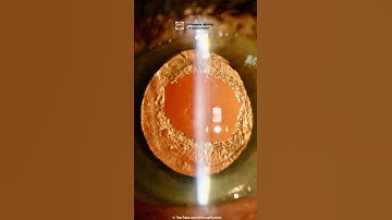 YAG Laser Capsulotomy.  #ophthalmology #cataracttreatment #cataractsurgeon #cataractdisease