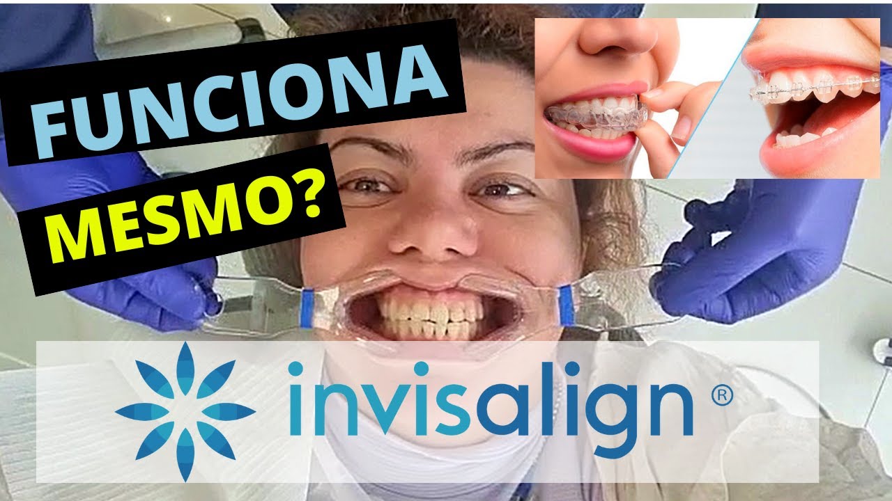 APARELHO INVISIVEL INVISALIGN