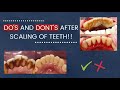 DO'S AND DONT'S AFTER SCALING OF TEETH | DENTO FRIEND