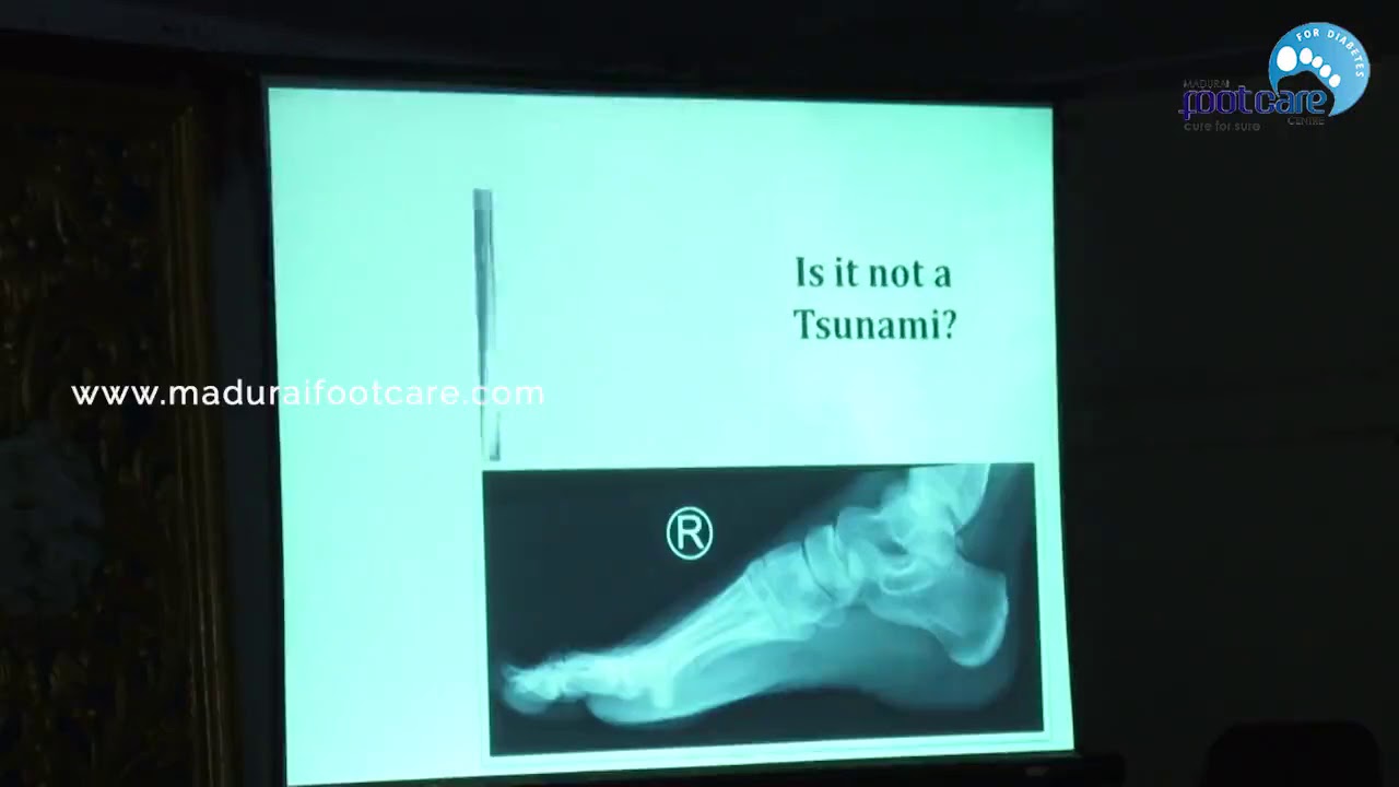 Surgical procedures in Diabetic foot Madurai Foot Care Centre