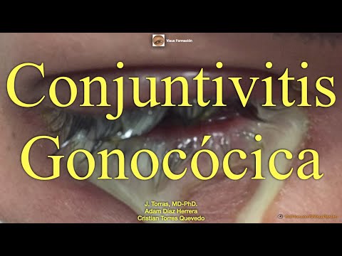 Video: ¿Qué es una conjuntivitis gonorreica?