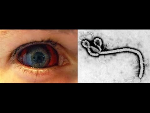 閲覧注意 エボラの実態がヤバ過ぎる 衝撃画像に鳥肌立ちまくり 日本上陸って Youtube