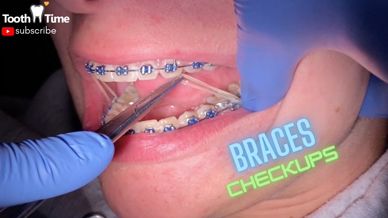 Braces Check up - Wire change 19x25 SS to 018SS - Tooth Time Family  Dentistry New Braunfels 