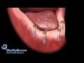 Patient Treatment Videos: Overdenture