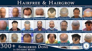 Indias Most Trusted Hair Transplant Clinic || Hairfree & Hairgrow Clinic || Hair Transplant Result