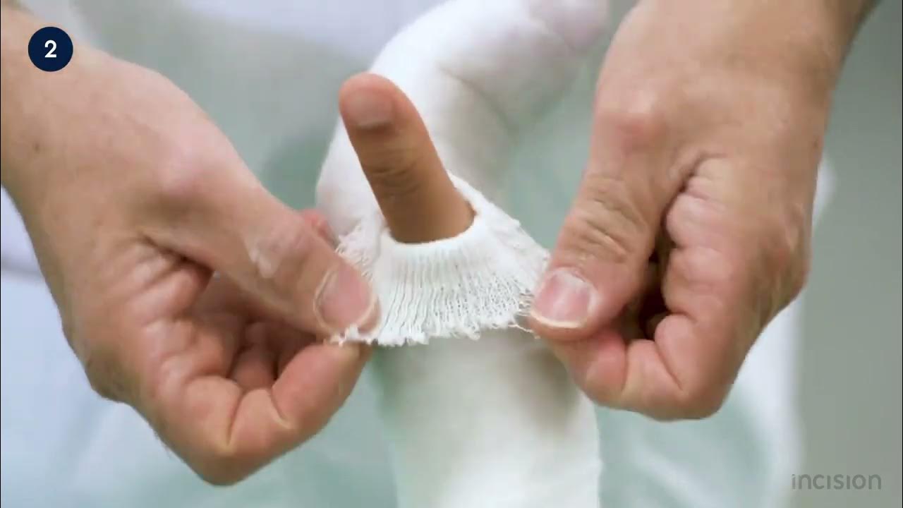 Radial Gutter Splint Steps
