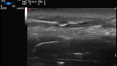 Come far seccare il granuloma?