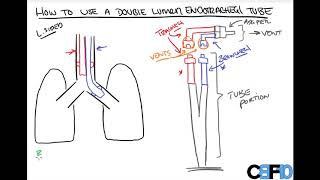 How to use a Double Lumen Endotracheal Tube