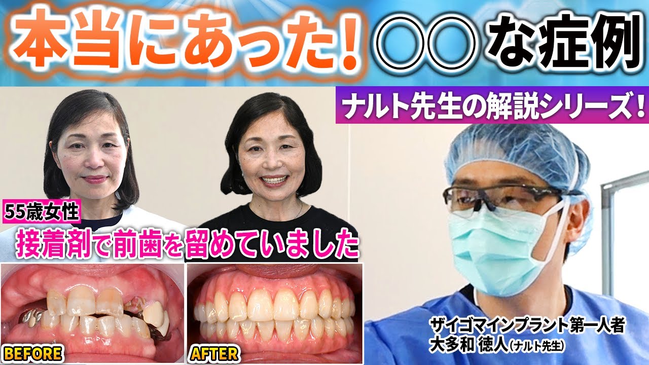 なんと前歯を接着剤で留めていた50代の女性が来院！オールオン4でナルト先生が1日で治したら…最高の笑顔を取り戻せた！本当にあった症例シリーズ