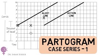 Partogram - Case Series 1