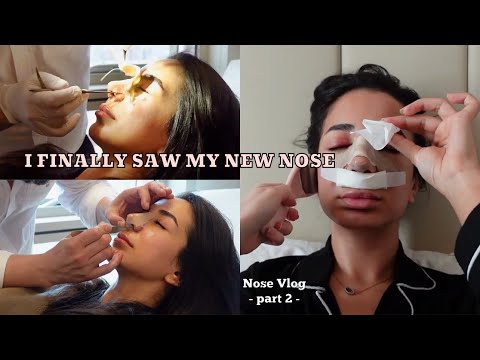 I GOT A NOSE JOB...AGAIN?! | CAST REMOVAL | DR EMRAH CELIK - NOSE JOB VLOG (PART 2)