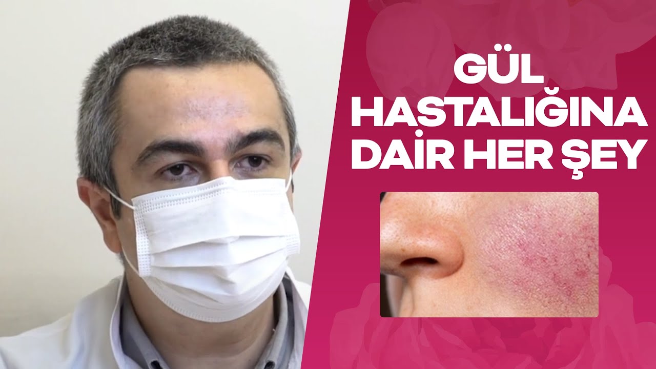 Gül Hastalığına Dair Her Şey! Rozasea Nedir? | Topicrem #gülhastalığı