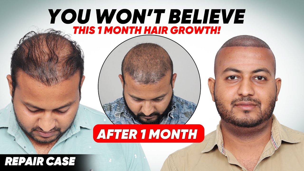 Best Hair Transplant in Hyderabad (HX-DXVD)| Best Results & Cost of Hair Transplant in Hyderabad