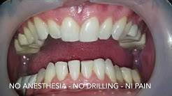 Hollywood Smile infinity lumineers veneers Dubai Beirut Doha