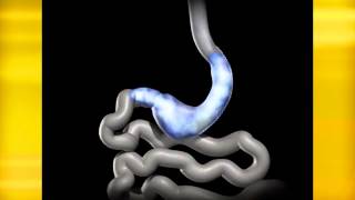 Bariatrics   Turnquest