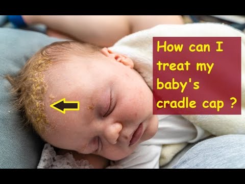 Video: 3 Möglichkeiten, Cradle Cap zu überwinden