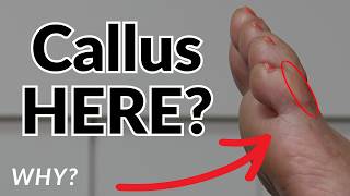 Callus On Your Pinky Toe? Heres What It Really Means