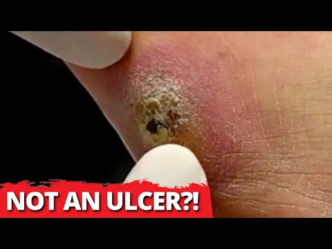 You'll Never Guess What This REALLY Is!! Not An Ulcer?! 😲 | Dr. Kim, Kim Foot and Ankle