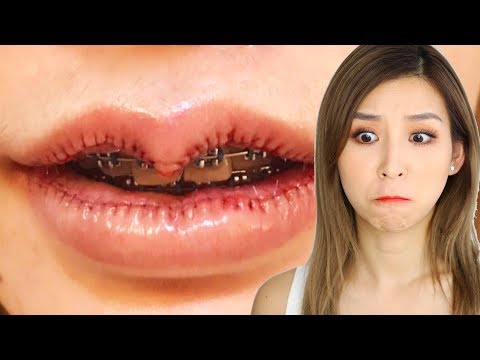 Video: Der Neue Trend: Lippenverkleinerung Mit Operation