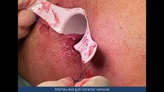 The use of the gull retractor in Milligan Morgan hemorrhoidectomy