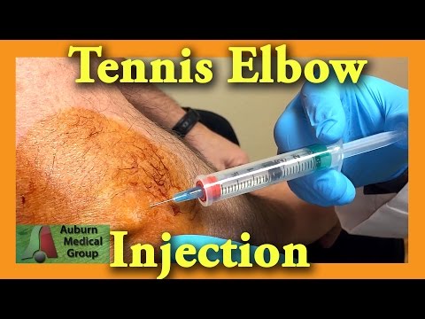 Tennis Elbow Injection Cortisone | Medical Group Auburn