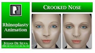 Rhinoplasty Animation - How can a Crooked or asymmetrical nose be straightened?