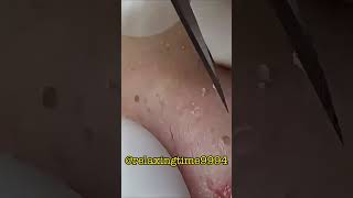 satisfying blackhead removal relaxing 10 shorts blackheads ance burnout