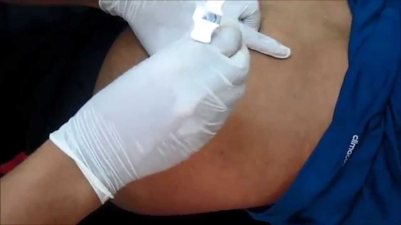 Administration of Intra gluteal injection-Locating the site - YouTube