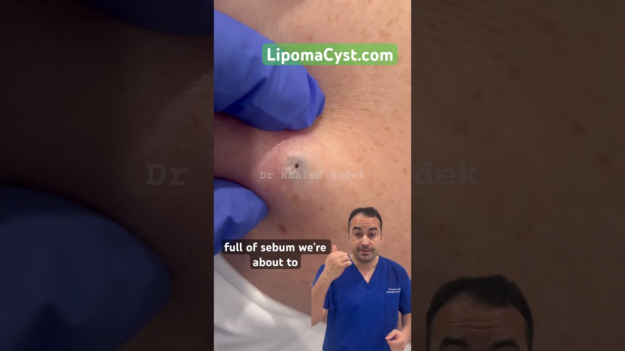 Expansive Blackhead Dr Khaled Sadek LipomaCyst Com