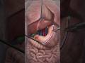 How Weight Loss Surgery | Sleeve Gastrectomy Explained