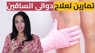 تمارين لعلاج دوالي الساقين