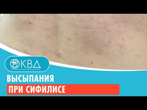 💣 Высыпания при сифилисе. Клинический случай №195