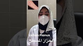 الحزاز المنبسط Lichen Planus