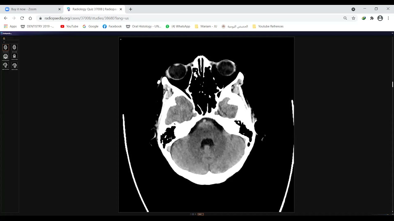To Radiology with Love 2021 - Scrolling a normal Brain CT without contrast