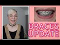 Braces Eight Month Update | Adult Braces Journey | Cayce Anne