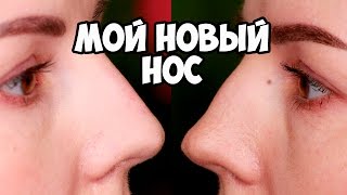 КОНТУРНАЯ ПЛАСТИКА БЕЗ ОПЕРАЦИИ | У МЕНЯ НОВЫЙ НОС!! КОНТУРНАЯ ПЛАСТИКА БЕЗ ОПЕРАЦИИ | У МЕНЯ НОВЫЙ НОС!!