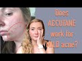 My Accutane Experience (MILD, persistent acne)