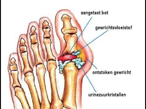 Zeg maar dag tegen jicht met deze natuurlijke middelen