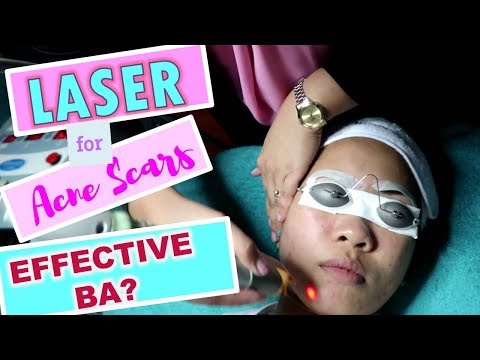 LASER TREATMENT FOR ACNE SCARS + BEFORE AND AFTER | Philippines