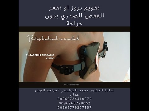 علاج بروز القفص الصدري قبل و بعد الدكتور محمد الترشيحي
