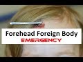 Removing a Foreign Body from a Child's Forehead