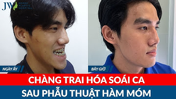 Phẫu thuật hàm móm giúp chàng trai Hàn Quốc mặt lưỡi cày thành hot boy vạn người mê
