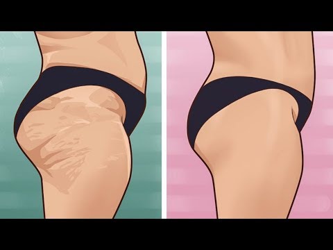 Video: Das Beste Natürliche Rezept Für Cellulite