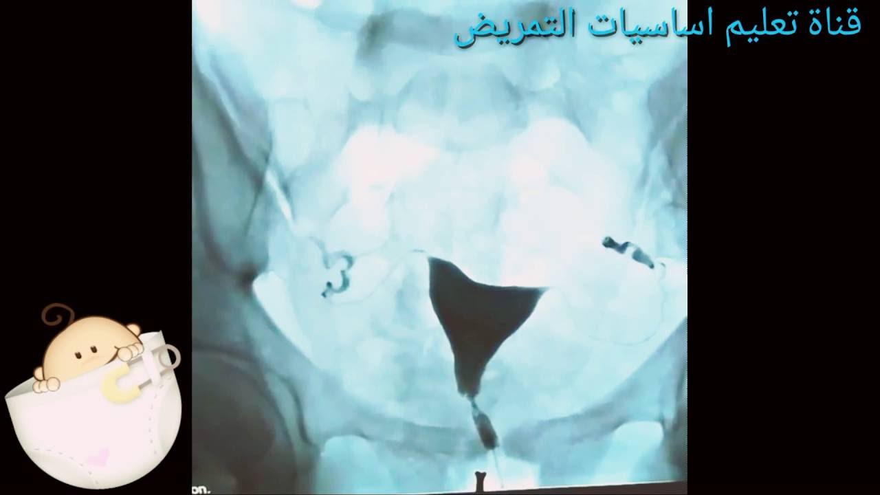 إجراءات تصوير الرحم والبوق