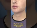 Thyroid Cancer Explained: How It Spreads &amp; Early Warning Signs | 3D Medical Animation