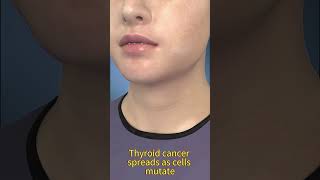 Thyroid Cancer Explained: How It Spreads &amp; Early Warning Signs | 3D Medical Animation