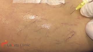 leg Spider Veins disappear like magic - Latest Sclerotherapy